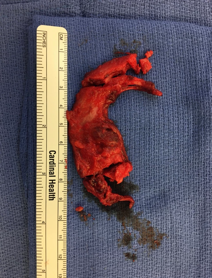 an excised first rib from venous thoracic outlet surgery
